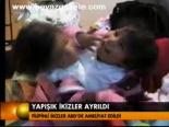 Yapisik İkizler Ayrıldı
