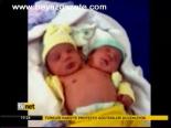 Brezilya'da İki Kafalı Bebek