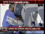 Göbek Deliğinden Obezite Ameliyatı!