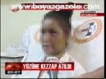 Yüzüne Kezzap Atıldı