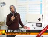 Görünmez diş teli