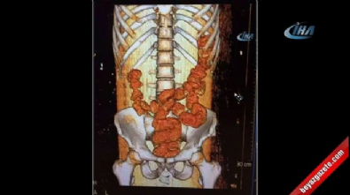Sindirim siteminden uyuşturucu çıktı 