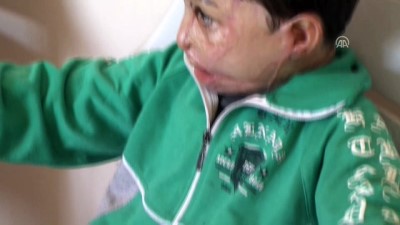 estetik ameliyat - İç savaş, Hasan'ın hayatını kararttı - HATAY  Videosu