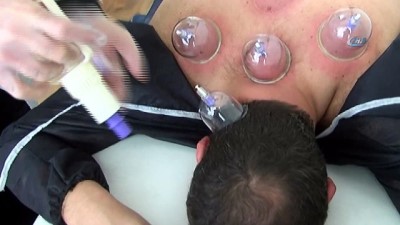akupunktur -  70 derde deva bir tedavi yöntemi: Hacamat  Videosu