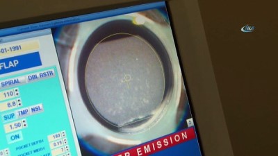 hipermetrop -  Excimer lazer ile gözlüklerden 5 dakikada kurtulun  Videosu