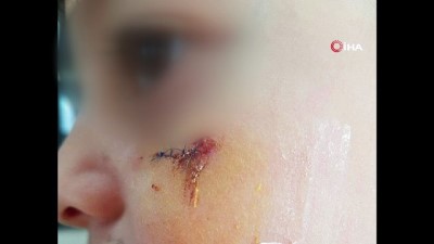 ogretmenlik -  Kitapla yaralanan öğrencinin ön raporu: 'Kalıcı iz oluştu'  Videosu