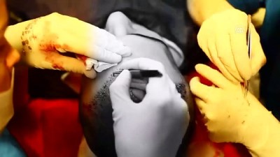 yuz nakli - Yanlış saç ekimi kalıcı sorunlara neden oluyor - ANTALYA  Videosu