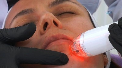 igne tedavisi -  Ergenlikte akne izlerine 'altın iğne' yöntemi  Videosu