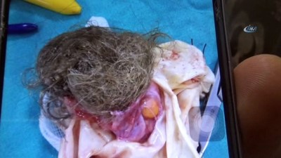 kadin hasta -  Kilo şikayetiyle gittiği hastanede karnından çıkan dev kitle şaşırttı  Videosu