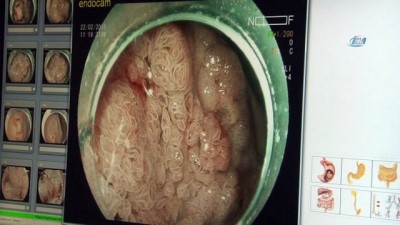 insan vucudu -  Mide ve kolon kanserine ameliyatsız çözüm  Videosu
