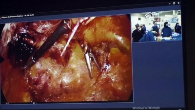 ameliyathane -  Yozgat'ta ilk kez interaktif katılımla kasık fıtığı ameliyatı yapıldı Videosu