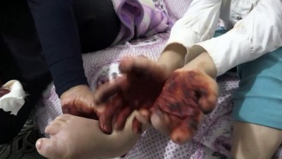 ayak parmaklari - Vücudunda yaralar çıkan 6 yaşındaki Beyza Nur tedavi için destek bekliyor - BATMAN  Videosu
