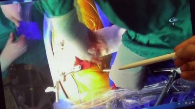 ameliyat -  Göğüs kafesi açılmadan delik kalbi ameliyat edildi  Videosu
