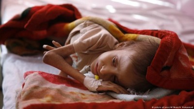 Yemen'de kıtlık çeken çocukların sayısı 1 milyon artabilir 