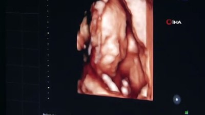 dogum orani -  Anne adaylarına dört boyutlu ultrasonla perinatoloji hizmeti  Videosu