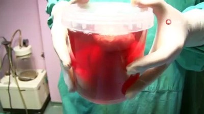 ameliyathane -  26 yaşındaki bir kızın karnından 15 santimlik miyom çıktı  Videosu