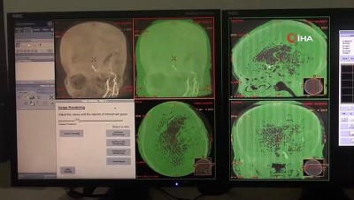 anatomi -  Kapalı sistem beyin ameliyatı ile tekrar yürümeyi başardı  Videosu