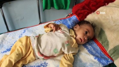  - WHO: 'Yemen'de 7,4 Milyon Çocuk Yetersiz Besleniyor'