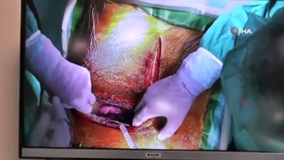 karaciger nakli -  Tıp’ta tarihi gün...Aynı anda 5 hastaya karaciğer nakli operasyonu başladı  Videosu