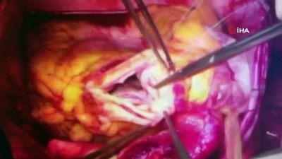 kalp ameliyati -  Türkiye’de ilk defa uygulanan kalp ameliyatı tekniğiyle hayata tutundu Videosu