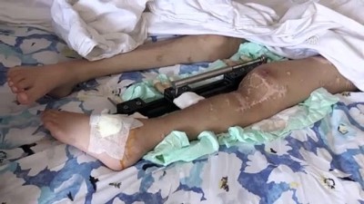 Suriyeli çocuk vücudunda şarapnel parçalarıyla yatağa mahkum yaşıyor - HATAY 