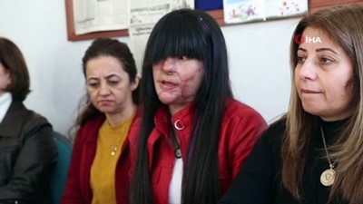 adam yaralama -  Erkek arkadaşının asitli saldırısına uğrayan Berfin'den Cumhurbaşkanı Erdoğan'a teşekkür  Videosu