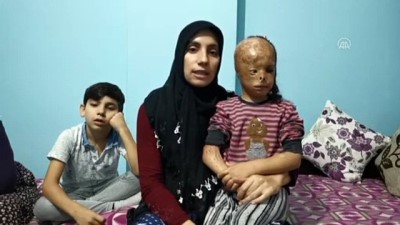 dis gorunus - KOCAELİ  - Bebekken yüzü yanan 5 yaşındaki Dilara ameliyat olmak için yardım bekliyor Videosu