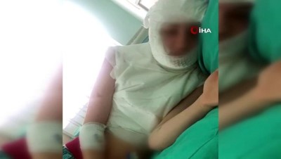 uvey anne -  Üvey kızını kaynar suyla yaktığı iddia edilen kadına 4,5 yıl hapis istemi Videosu