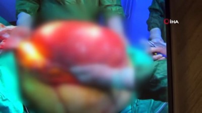 askeri hastane -  Safra kesesi şikayeti ile geldi, karnından 15 kilonun üzerinde tümör çıktı Videosu