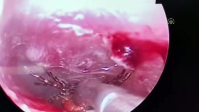 acil servis - ERZİNCAN - Ağrı şikayetiyle hastaneye başvuran kadının kulak zarından kene çıktı Videosu
